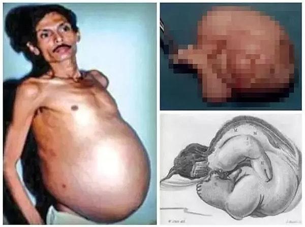 Mutasyona uğramış bu embriyonun Bhagat'ın midesi içerisinde büyüdüğünü ve onun içerisinde kendisi ile 36 yıl boyunca yaşadığı fark edildi. Ameliyat ile çıkarılan bu canlı mutasyon birkaç dakika sonra öldü.