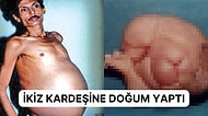 Tam 36 Yıl Boyunca İkiz Kardeşini Karnında Taşıyan Adamın Filmlere Konu Olacak Akılalmaz Hikayesi