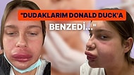 Dudak Dolgusunu Eriteyim Derken Donald Duck'a Benzeyen Bahtsız Kadın Başından Geçenleri Anlattı!