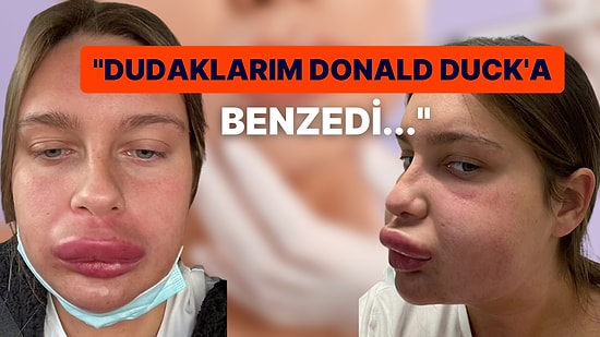 Dudak Dolgusunu Eriteyim Derken Donald Duck'a Benzeyen Bahtsız Kadın Başından Geçenleri Anlattı!