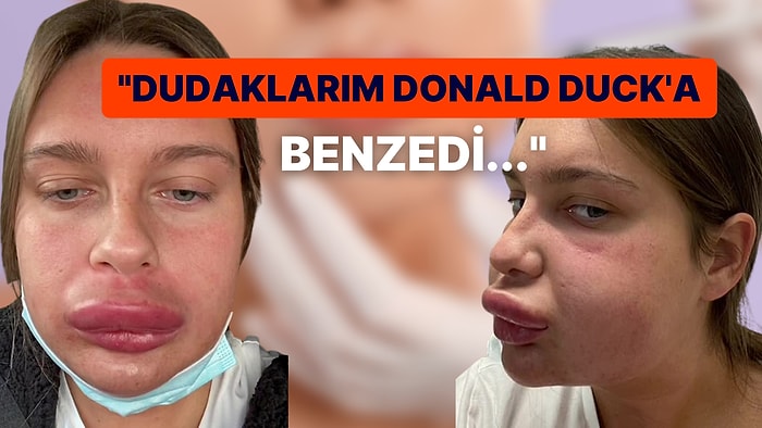 Dudak Dolgusunu Eriteyim Derken Donald Duck'a Benzeyen Bahtsız Kadın Başından Geçenleri Anlattı!