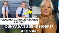 Oldukça Nadir Görülen Genetik Bir Durum Nedeniyle Köprücük Kemiği Olmadan Dünyaya Gelen Kadın