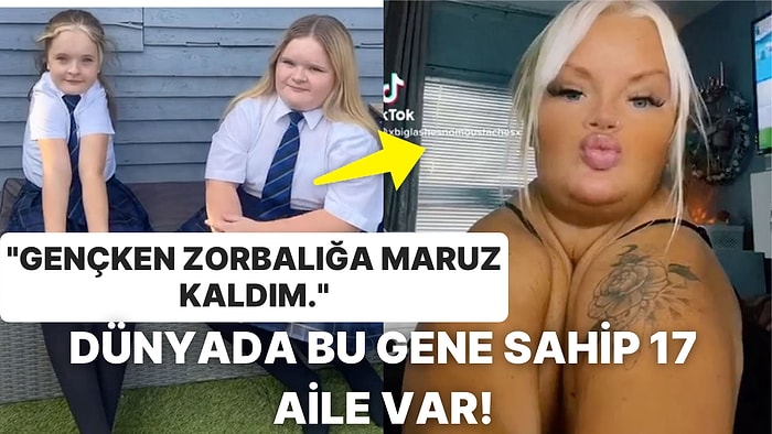 Oldukça Nadir Görülen Genetik Bir Durum Nedeniyle Köprücük Kemiği Olmadan Dünyaya Gelen Kadın