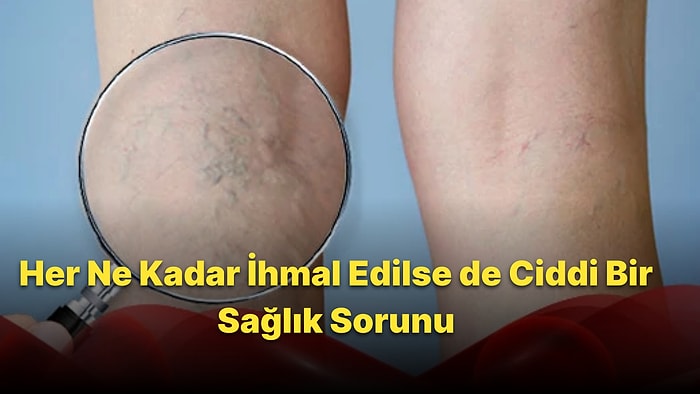 Dünyanın En Yaygın ama En İhmal Edilen Hastalığı: Varis