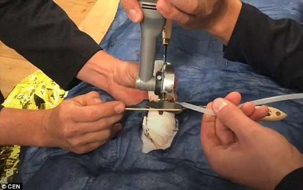 Elektrikli testere ile hastaneye gelen ekip dikkatli bir çalışma ile yüzüğü kesti. Tabii ki penise zarar vermeden kesebilmek için saatlerce uğraştılar.