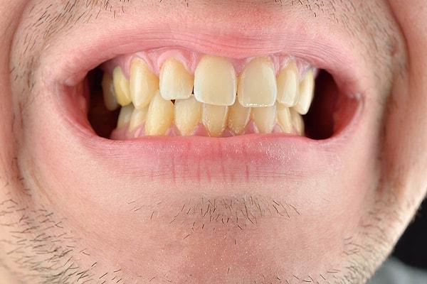 Dişlerinizi her gün fırçalamamak ve diş ipi kullanmayı ihmal etmek ağız kokusuna davet çıkarır.