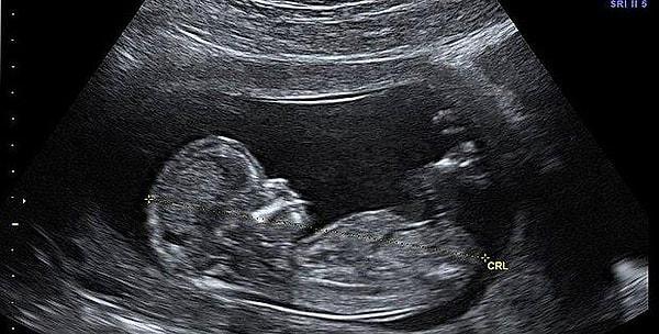 “Bana tekrar test yaptılar. Pozitif çıktı. Ultrason filmi çekildi. Ekranda onu gördüm. Hamileydim!”