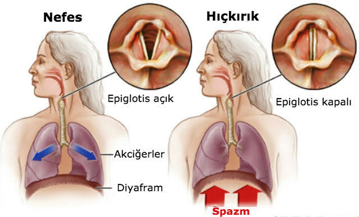 Neden Hıçkırırız? Hıçkırığın Altında Yatan ve Kimselerin Pek Bilmediği Sebebi Duyunca Çok