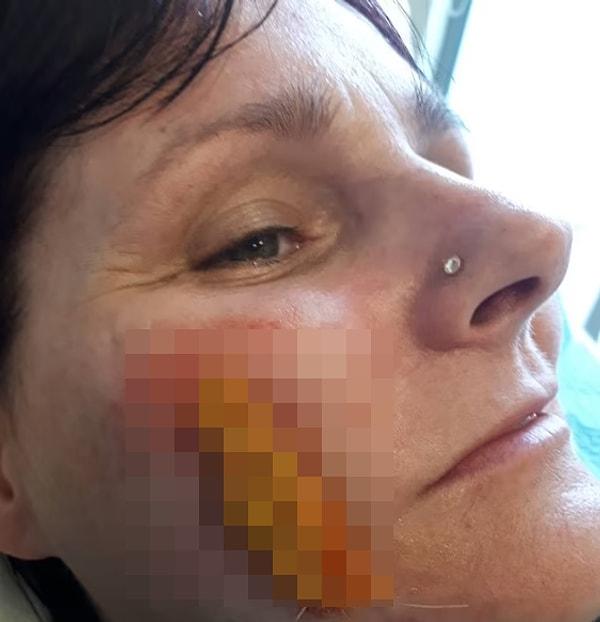 Otelde çalışan 45 yaşındaki kadın, yanağı kaşınınca bezle sildi. Bunun sonucunda cildi yakabilecek sertlikteki alkali kimyasal yüzüne yayıldı.