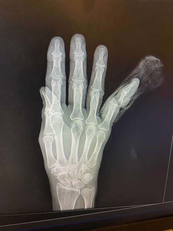 11. "Zavallı karım parmağını kesti ama yarısından kesmiş gibi."