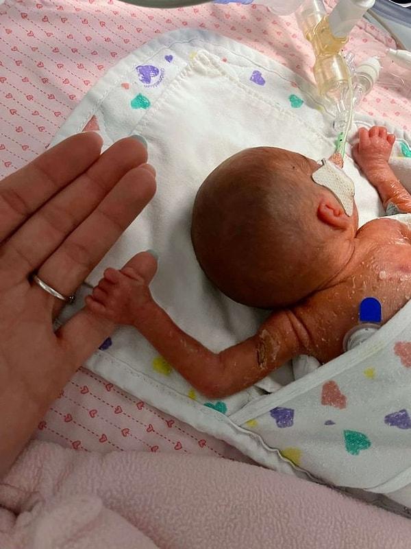 Doktorlar, bebeğin beyninde ikinci seviye kanama ve kalbinde bir delik olduğunu söyledi.