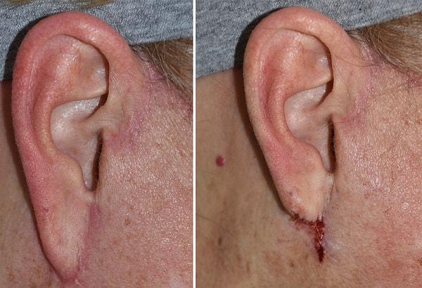 1. Dr Banwell'e göre birinin yüz germe ameliyatı olduğunu anlamanın en bariz işaretlerinden biri "elf kulakları".