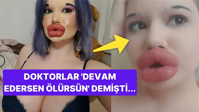 Ölümcül Olduğunu Bilmesine Rağmen Güzelleşmek Uğruna Dudaklarını Yaptırmaya Devam Eden İlginç Kadın