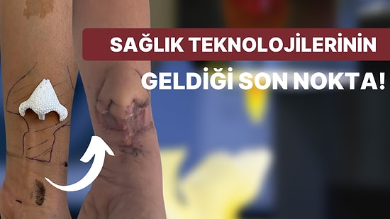 Üç Boyutlu Yazıcıdan Üretilen Burun, Hastanın Kolunda Geliştirildikten Sonra Yüzüne Nakledildi