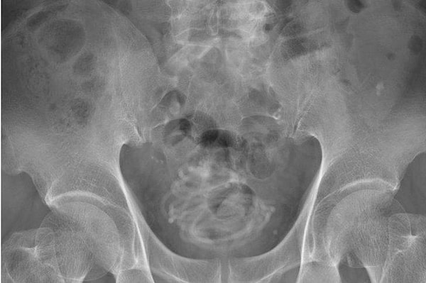 Uzmanlar, idrar yapma konusunda zorluk yaşadıktan sonra röntgeni çekilen adamla ilgili daha önce böyle bir görmediklerini dile getirdi.