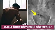 Ağrısı Olduğu İçin Hastaneye Gittikten Sonra Penisinden 2 Metrelik İp Çıkarılan Adamın Beyin Yakan Hikayesi