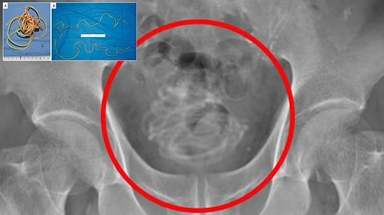 В Японии врачи обнаружили в пенисе 79-летнего мужчины двухметровую веревку от скакалки