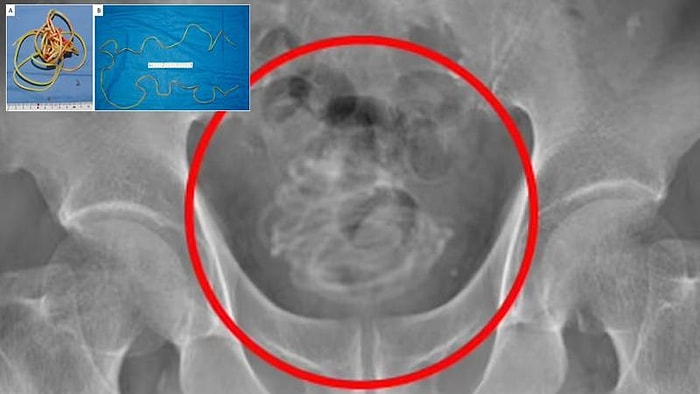 В Японии врачи обнаружили в пенисе 79-летнего мужчины двухметровую веревку от скакалки