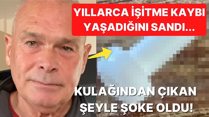 5 Yıl Boyunca İşitme Kaybı Yaşadığını Zanneden Adamın Kulağının İçinden Çıkan Şeye İnanamayacaksınız!