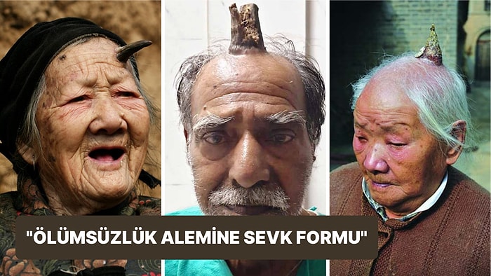 Kolunda 7 Santimetre Uzunluğunda Boynuz Çıkan 91 Yaşındaki Kadını Görenler Gözlerine İnanamadı!