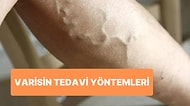 Dünyanın En Yaygın Ama En İhmal Edilen Hastalığı Varis 3: Tedavi