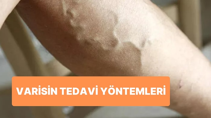 Dünyanın En Yaygın Ama En İhmal Edilen Hastalığı Varis 3: Tedavi