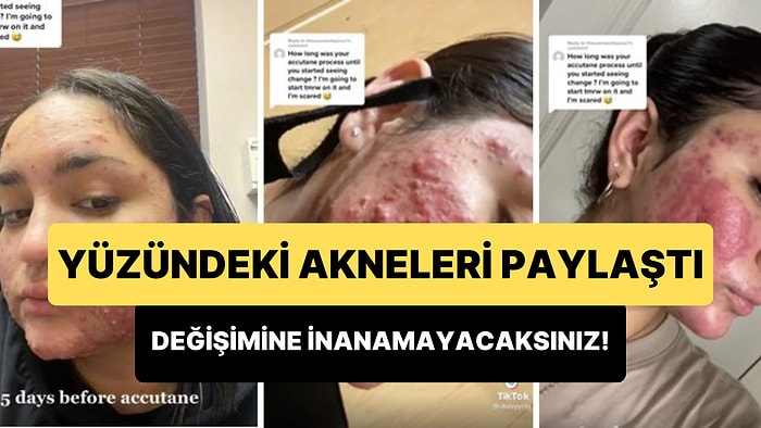 Yüzündeki Akneler İçin İlaç Kullanan Kadın Gün Gün Yaşadığı Değişimi Paylaştığı Videosu ile Viral Oldu