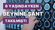 Bacağında Hissizlik Yaşayan Hastanın Beyninin Küçüldüğünü Gören Doktorlar Hayrete Düştü