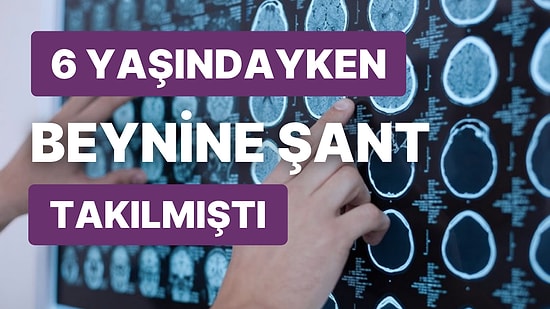 Bacağında Hissizlik Yaşayan Hastanın Beyninin Küçüldüğünü Gören Doktorlar Hayrete Düştü