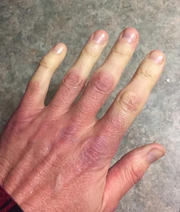 10. "Raynoud hastalığım olduğu için soğuk havadan döndüğüm zaman kan dolaşımım eski haline dönüyor.  Bu sırada parmaklarım böyle görünüyor."