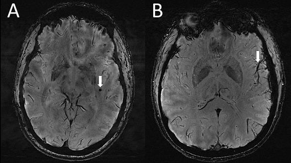 Los Angeles'ta bulunan Güney Kaliforniya Üniversitesi'ndeki bilim insanları, migren hastalarından ayrıntılı MRI taramalarını topladı.