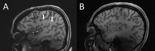 Ekip, her iki migren grubunda da, beynin belirli bölgelerindeki kan damarlarının yakınında bulunan genişlemiş perivasküler boşluk buldu. Bu boşluklar, beynin merkezi beyaz madde alanı olan centrum semiovale'de en belirgin şekilde gözüküyordu.