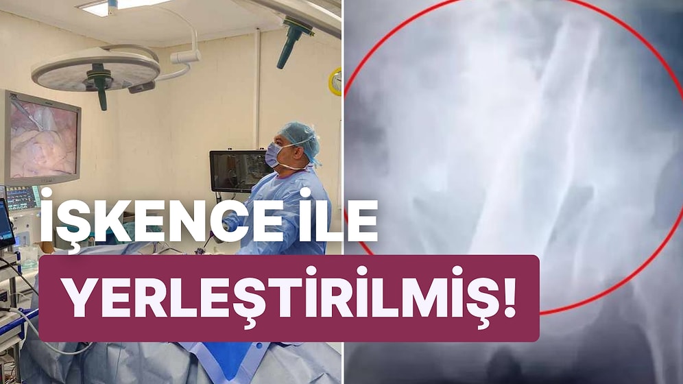 Acı İçerisinde Acil Servise Giden Adamın Makatından Çıkan Cisim Gören Herkesin Kanını Dondurdu!