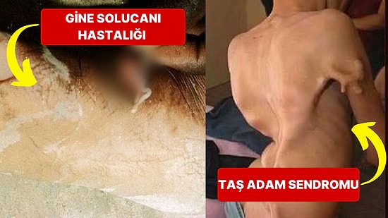 Varlığına İnanmakta Zorluk Çekeceğiniz Yeryüzündeki Birbirinden İlginç ve Korkunç Hastalıklar