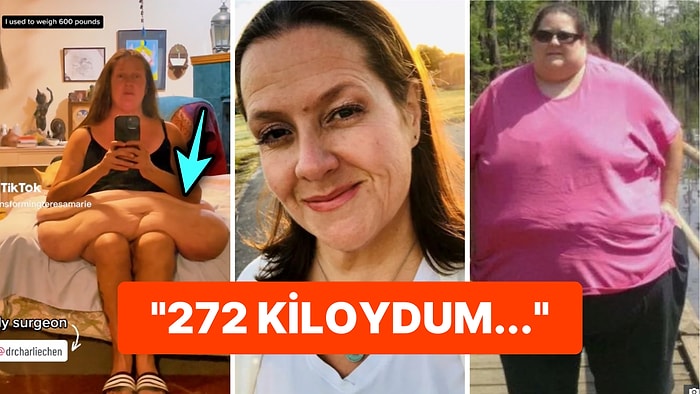 Hayatını Kurtarmak İçin 167 Kilo Veren Kadının Ameliyattan Önceki Görüntülerine İnanamayacaksınız!