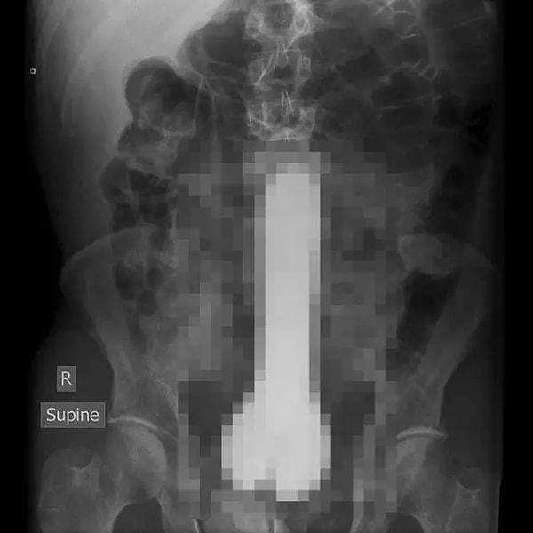 4. “Acile servise gelen bir kadının röntgen filmini buraya bırakmak istiyorum…”