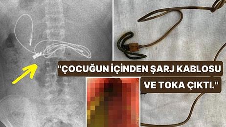 Karın Ağrısıyla Hastaneye Giden ve Şarj Kablosu Yuttuğu Ortaya Çıkan Diyarbakırlı Çocuk Uluslararası Basında!
