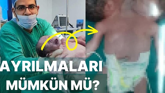 Milyonda Bir Görülen Vaka: İki Başlı, Dört Kollu ve İki Bacaklı Olarak Doğan İkizler Doktorları Şoke Etti!