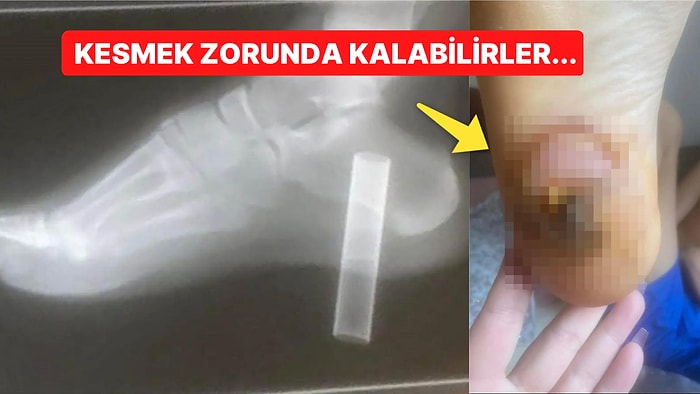 Ayağına Elektronik Sigara Saplanan 13 Yaşındaki Çocuğun Yaşadığı Korkunç Olayı Mutlaka Duymalısınız!