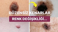 Benlerin Şekline ve Rengine Göre Kanserli Olup Olmadığı Nasıl Anlaşılır?