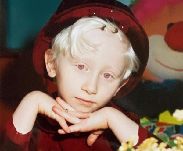 Ailesindeki ikinci albino çocuk olarak dünyaya geldi.