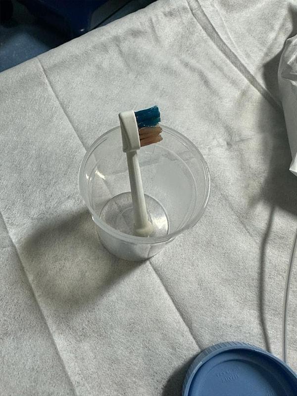 Suudi Arabistan'daki doktorlar, 9 yaşındaki bir çocuğun midesinde elektrikli bir diş fırçası buldular.