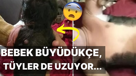 Vücudunun Neredeyse Tamamı Kılla Kaplı Doğan Bebek Doktorları Hayrete Düşürdü!