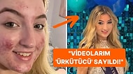 Güzellik Yarışmasında Birinci Olan Genç Kızın TikTok Hesabı Sivilceleri Nedeniyle Kapatıldı!