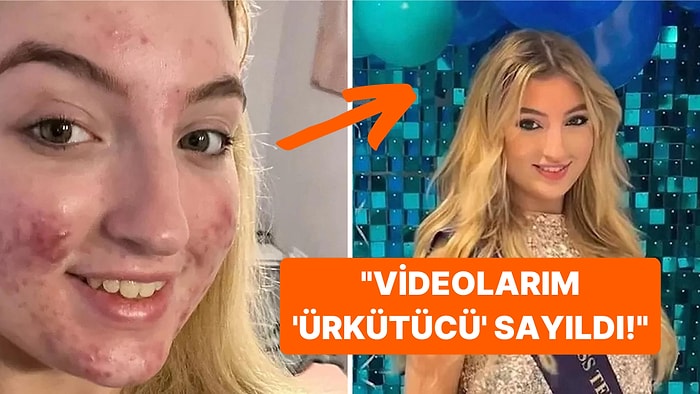 Güzellik Yarışmasında Birinci Olan Genç Kızın TikTok Hesabı Sivilceleri Nedeniyle Kapatıldı!