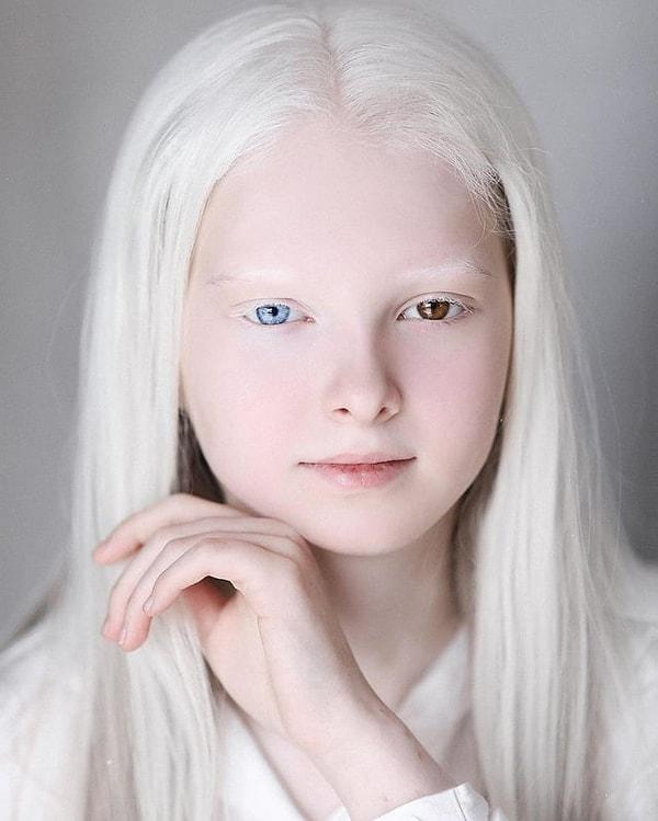 4. Kendisine iki nadir genetik durum, albinizm ve heterokromi teşhisi konulan Amina Ependieva👇