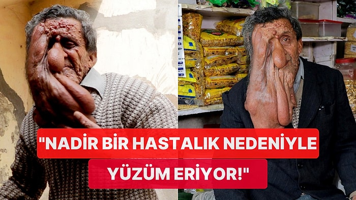 Nadir Bir Hastalık Nedeniyle Yüzü Eriyen Adamın Akıllara Durgunluk Veren Hikayesi