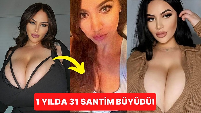 Memeleri Sürekli Büyüyor! Nadir Bir Hastalık Yüzünden Yıllardır Acı Çeken Kadının Hayrete Düşüren Hikayesi