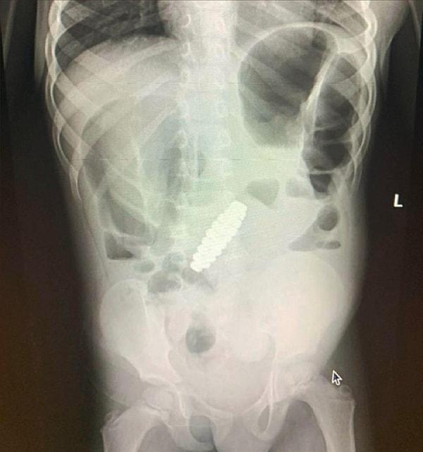 4 yaşındaki bir çocuk "kolik karın ağrısı" şikayetiyle hastaneye kaldırıldı.