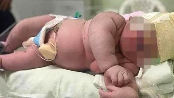 Brezilya'nın Amazonas eyaletinde 7 kilo ve 57 santim olarak dünyaya gelen Angerson Santos bebek doktorları hayrete düşürdü.